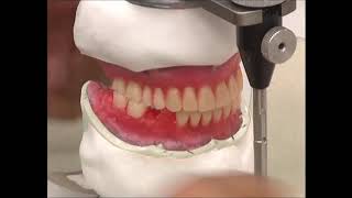 COMPLETE DENTURE 11 Teeth Setting Up  The Posterior Mandibular Teeth [upl. by Modesta387]