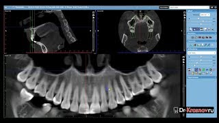 Использование панорамного модуля для диагностики КЛКТ в Planmeca Romexis [upl. by Isador]