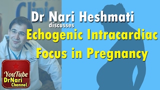 EICF Echogenic Intracardiac Focus on Ultrasound in Pregnancy Discussed by Dr Nari Heshmati [upl. by Nirrok601]