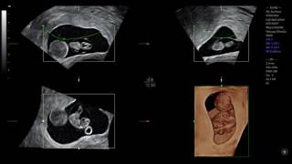 Prenatal diagnosis of a chorionic bump [upl. by Wolfgang]