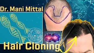 Dr Mani Mittal Hair Cloning Verteporfin Stem Cells Hair Transplant Artistry [upl. by Born556]