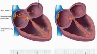 Difference Between Atrial Fibrillation and Atrial Flutter [upl. by Ayokahs]