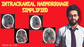 Intracranial Haemorrhage Simplified  ExtraduralSubdural and Subarachnoid Haemorrhage explained [upl. by Cliff]