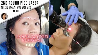 Another Microblading Removal Session What worked and What didntPart 3 [upl. by Anjali]