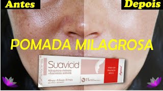 SUAVICID TUDO SOBRE A POMADA MILAGROSA PARA MANCHAS e MELASMA  SUAVICID ANTES E DEPOIS [upl. by Willis]