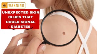 Diabetes EXPERT Reveals 13 Shocking Skin Warning Signs [upl. by Yenttirb]