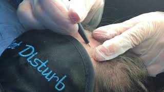 Hairline Electrolysis For Women [upl. by Casilda]