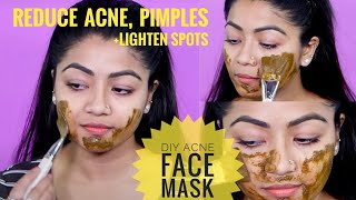 DIY ACNE FACE MASK For Acne Prone Skin  Lighten Acne Spots and Pimple Marks [upl. by Auqinehs]