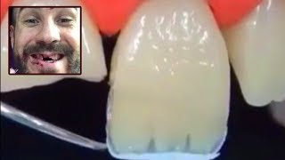 Cesaros Teeth Knocked Out Dental Restoration Procedure [upl. by Kramlich460]