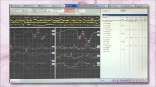 Evoked Potentials  SEP Tibial Nerve [upl. by Haianeb587]