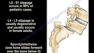 SpondylolysisSpondylolisthesisSpondylitis Spondylosis EverythingYou Need To Know Dr Nabil Ebraheim [upl. by Cahan]