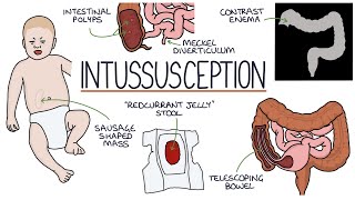 Understanding Intussusception [upl. by Attenyl]