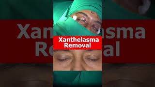 XANTHELASMA Removal Treatment At Shobhit Aesthetics [upl. by Vorfeld]