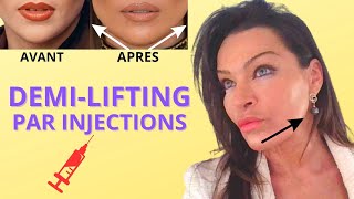 DEMILIFTING PAR INJECTIONS bas du visage et cou sans chirurgie et sans cicatrice cest possible [upl. by Claudina]