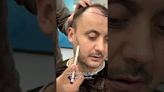 The Philosophy of Hair by Dr Ali Sahan hairtransplant beardtransplantturkey [upl. by Mcnamara894]