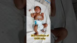 Skin condition of IUGR baby ytshorts shorts trending viralvideo shortsviral new skincare [upl. by Eeneg]