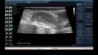 IQ 315 PYOMETRA ULTRASOUND ECHOPAC ANALYSIS UTERUS 2 [upl. by Adamson573]