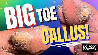 Big Toe Callus [upl. by Kenny]