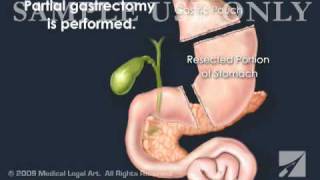 RouxenY Gastric Bypass Surgery [upl. by Dnallor]