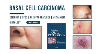 Basal cell carcinoma  Epithelial Pathology  Histology  Etiology  Oral Pathology [upl. by Anileuqcaj]