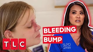 Dr Lee Gets Help To Remove A Bumpy Birthmark  Dr Pimple Popper [upl. by Amalee]