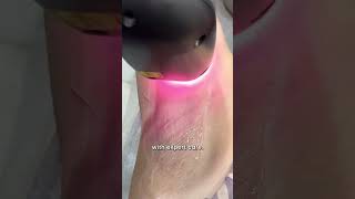 Underarm Laser Hair Reduction Everything You Need To know  Dr Sarin [upl. by Mark]