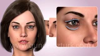 Cosmetic Eye Surgery  Upper and Lower Eyelid Aesthetic  Blepharoplasty Guncel Ozturk MD  DRGO [upl. by Ahsimet]