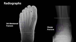 Ankle Sprains  Knowledgeable Treatment Matters  San Francisco Foot and Ankle Specialist  FDFAC [upl. by Surtemed]