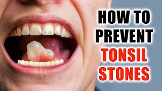 Natural Home Remedies for Tonsil Stones Relief [upl. by Ayrotal]