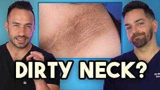 Dark Neck Armpits Groin How to Treat and Prevent Acanthosis Nigricans [upl. by Amir750]