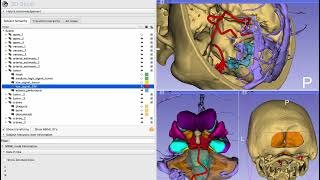 Posterior cranial fossa tumors Neurosurgical planning [upl. by Ayotol]