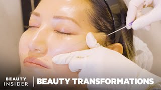 How Nonsurgical FaceLifts Work With PDO Threads  Beauty Transformations  Insider Beauty [upl. by Essilevi555]