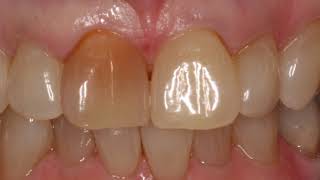 How to whiten single discoloured tooth  Dentist in Skelmersdale [upl. by Enelav]