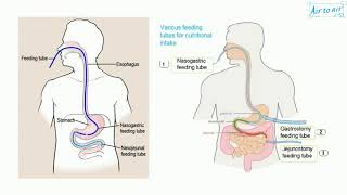 ileus [upl. by Nelloc]