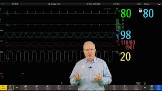 Philips IntelliVue Patient Monitoring  6  Changing a Wave [upl. by Hada]