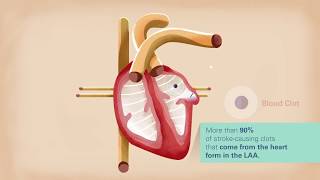 St Elizabeths Medical Center Watchman Procedure [upl. by Rebmetpes]