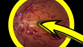 What is a Central Retinal Vein Occlusion [upl. by Eidnas]