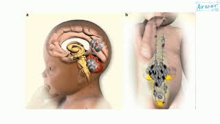 medulloblastoma [upl. by Idna]