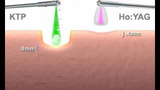 Greenlight Laser Die Wirkung eines KTPLasers und eines HoYAGLasers im Vergleich [upl. by Ronacin]