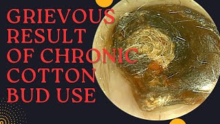 GRIEVOUS Result Of Chronic Cotton Bud Use Very Satisfying Earwax Removal [upl. by Findlay514]