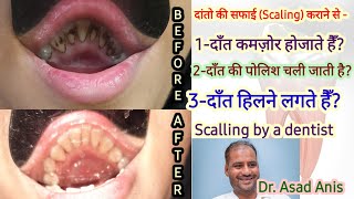 How teeth are cleaned at dentistदांतोकी सफाई कब कराना ज़रूरीहोताहैscalling advantage disadvantage [upl. by Lehpar985]