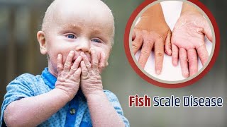 genetic disease ichthyosis vulgaris treatment videos fish scale disease treatment [upl. by Ricoriki]