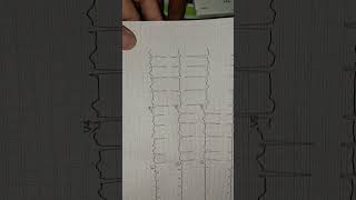 Atrial Fibrillation ECG [upl. by Mientao772]