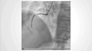 Decoding the NoReflow Phenomenon Coronary Microcirculations Role [upl. by Raye]