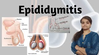 Epididymitis [upl. by Johppa]