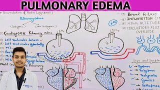 pulmonary edema pathophysiology in Hindi  cardiogenic pulmonary edema [upl. by Ecirtemed871]