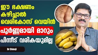 ഈ ഭക്ഷണങ്ങൾ കഴിച്ചു വെരികോസ് വെയ്ൻ പൂർണമായി മാറ്റം Vericose Treatment in Malayalam  Dr Shimji [upl. by Lehsar]