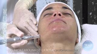 MicroPuncture Lab Biologique Recherche Carolina de la Rosa [upl. by Rochette418]