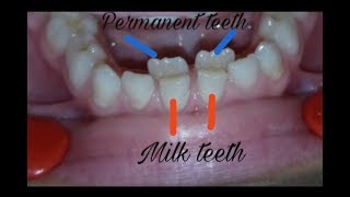 Over retained deciduous teeth milk teeth extraction  dental issues [upl. by Radcliffe]