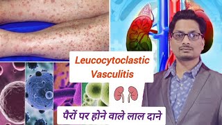 पैरों पर होने वाले लाल दाने  Leucocytoclastic Vasculitis Sudden Red Spots on Leg Palpable Purpura [upl. by Emse]